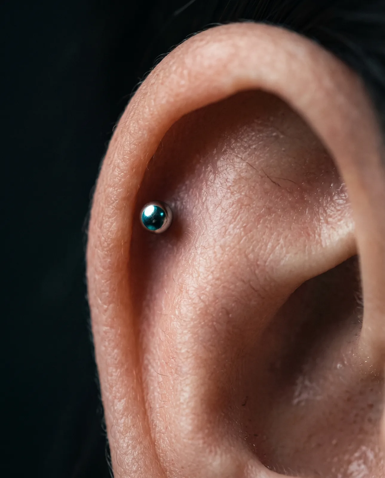 Healed helix piercing with an implant-grade titanium stud